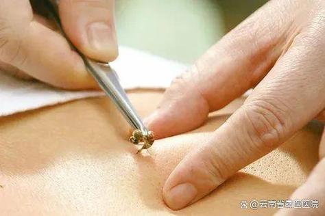 蜂疗对风湿类风湿有效吗