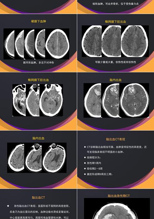 脑梗跟脑淤血有什么区别