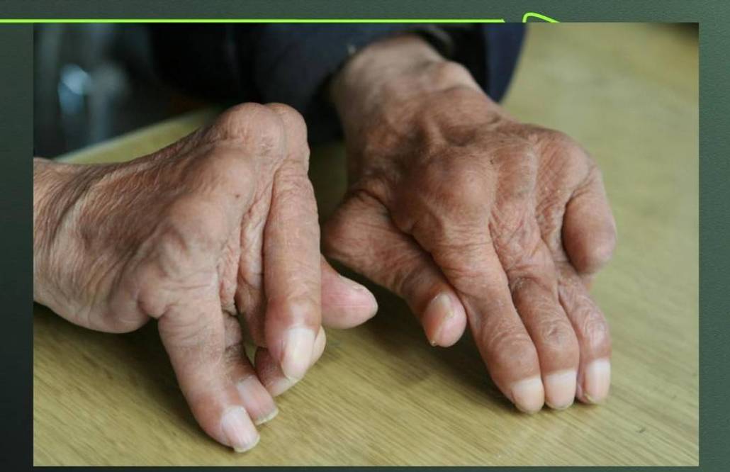 风湿 类风湿关节炎症状