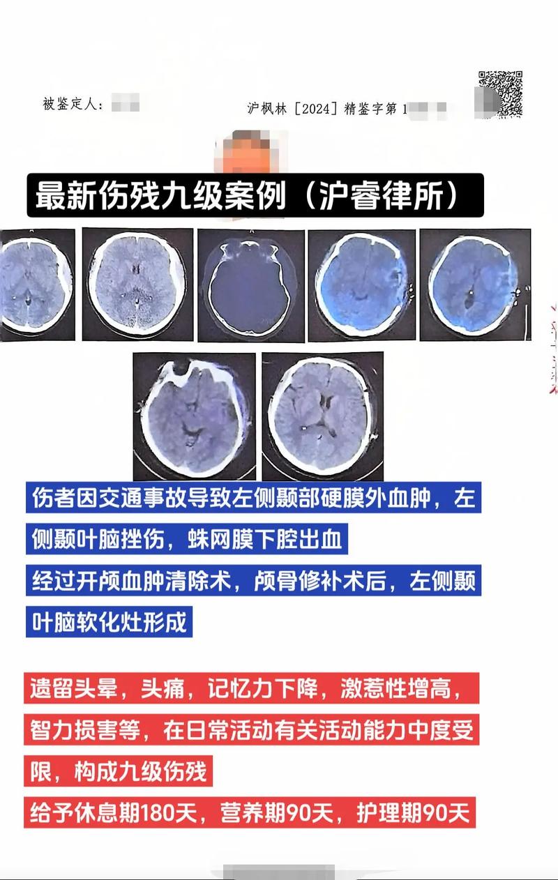脑梗脑疝开颅手术危险期