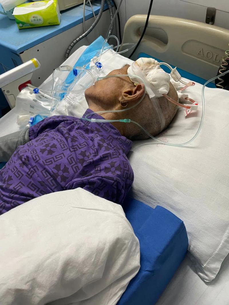 脑梗脑疝开颅手术危险期