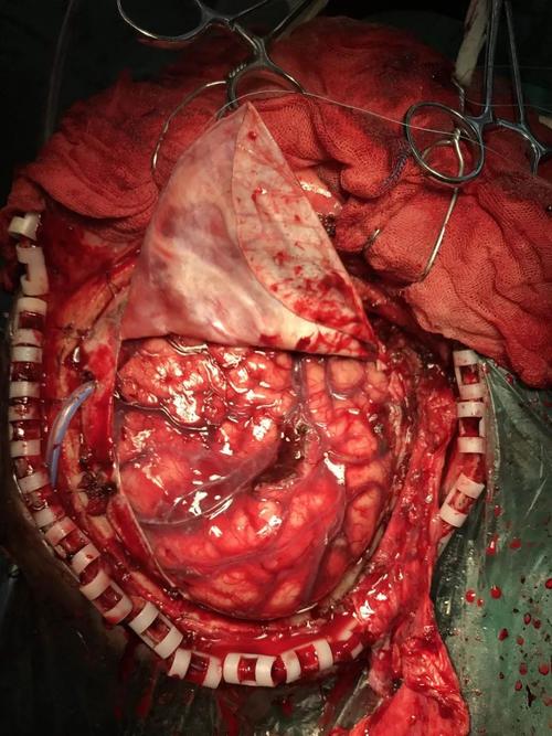 脑梗脑疝开颅手术危险期