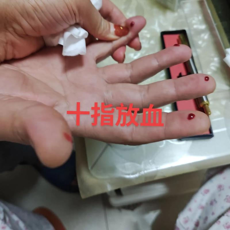 小儿急救手指放血穴位