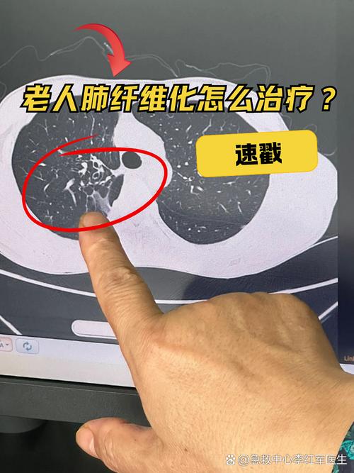 内风湿和类风湿和肺纤维