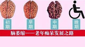 脑供血不足脑梗小脑萎缩