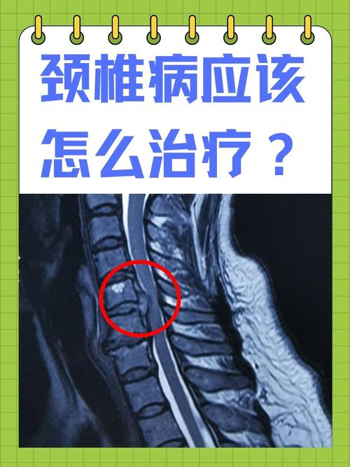 颈椎病是风湿还是内风湿