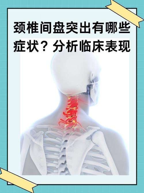 颈椎病是风湿还是内风湿