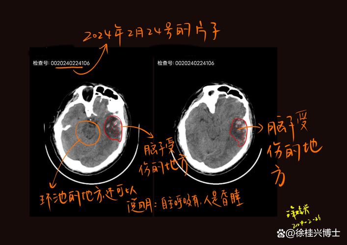 脑梗与脑脓肿的核磁区别
