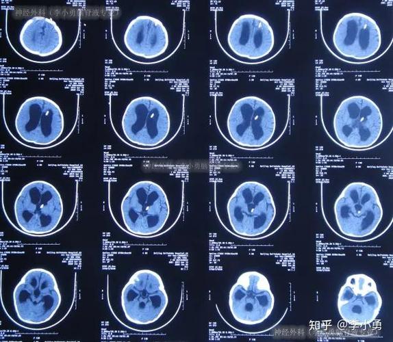 脑梗与脑脓肿的核磁区别