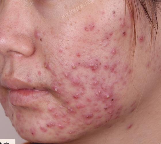 风湿类风湿长痘痘青春痘