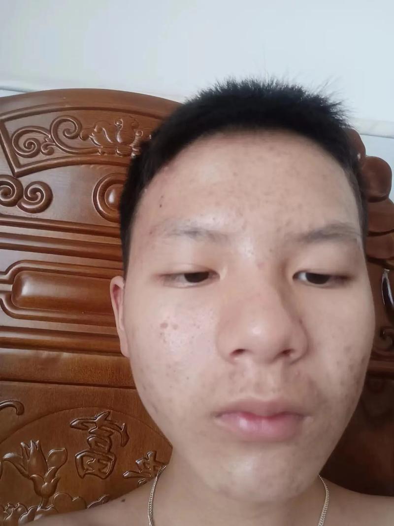 风湿类风湿长痘痘青春痘