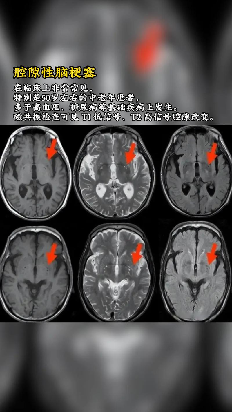 脑ct没脑梗核磁会有吗
