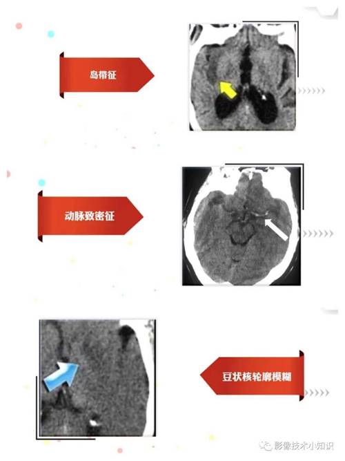 脑彩超能查脑血栓和脑梗