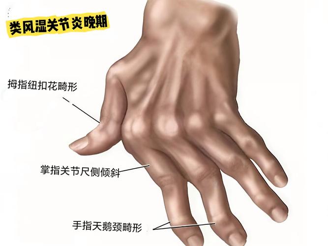 类风湿和风湿症状有哪些