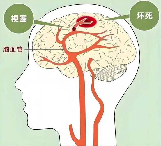脑梗和脑动脉硬什么严重