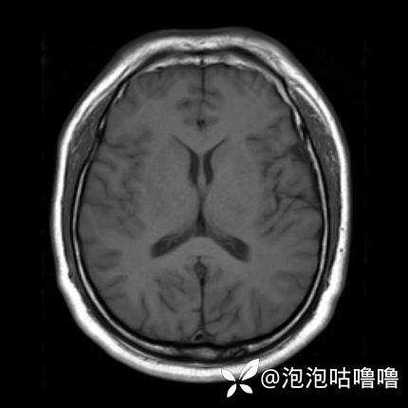 ct能看出脑主干脑梗吗