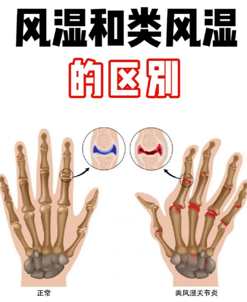 风湿和内风湿关节炎区别