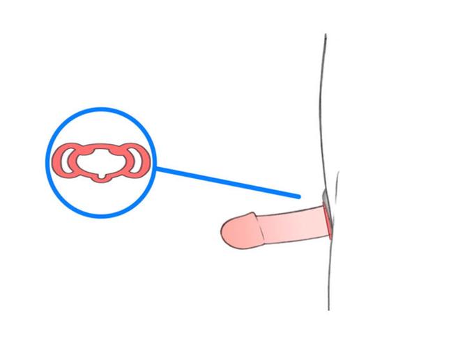 穴位按摩治疗勃起障碍