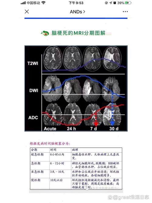 急性脑梗mri dwi