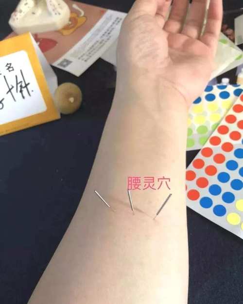 腰痛针灸治疗哪个穴位