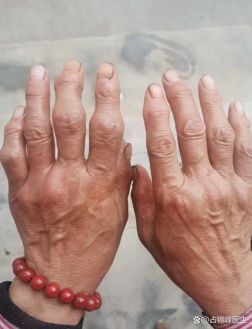 手指痛是类风湿还是风湿