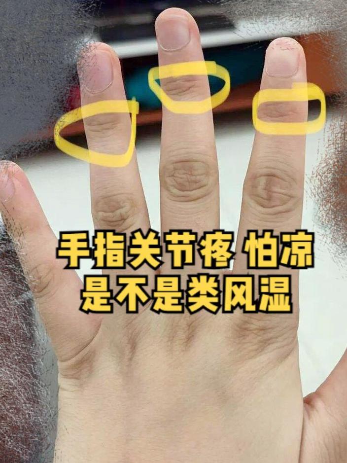 手指痛是类风湿还是风湿