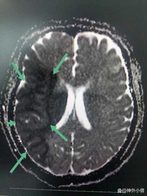 脑ct有脑梗需要手术吗