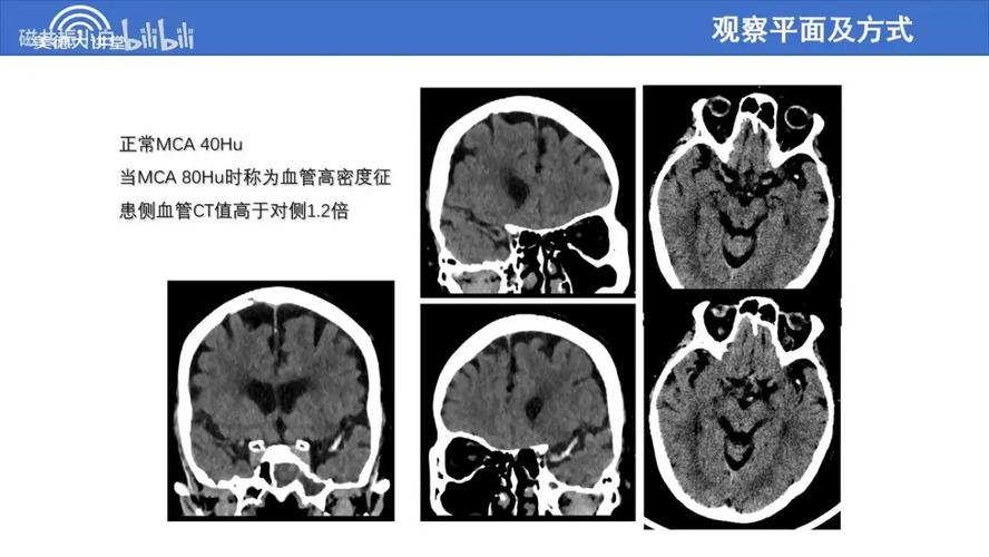 脑ct有脑梗需要手术吗