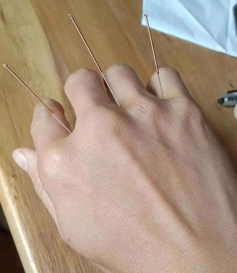 身体震颤针灸哪个穴位