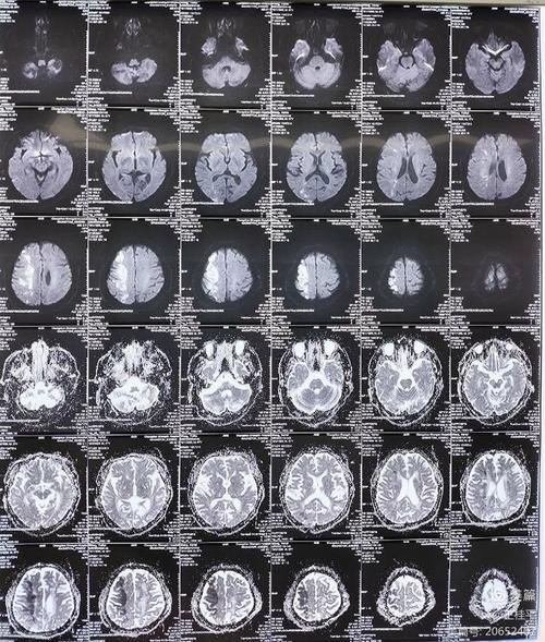 做脑CT可以查到脑梗吗