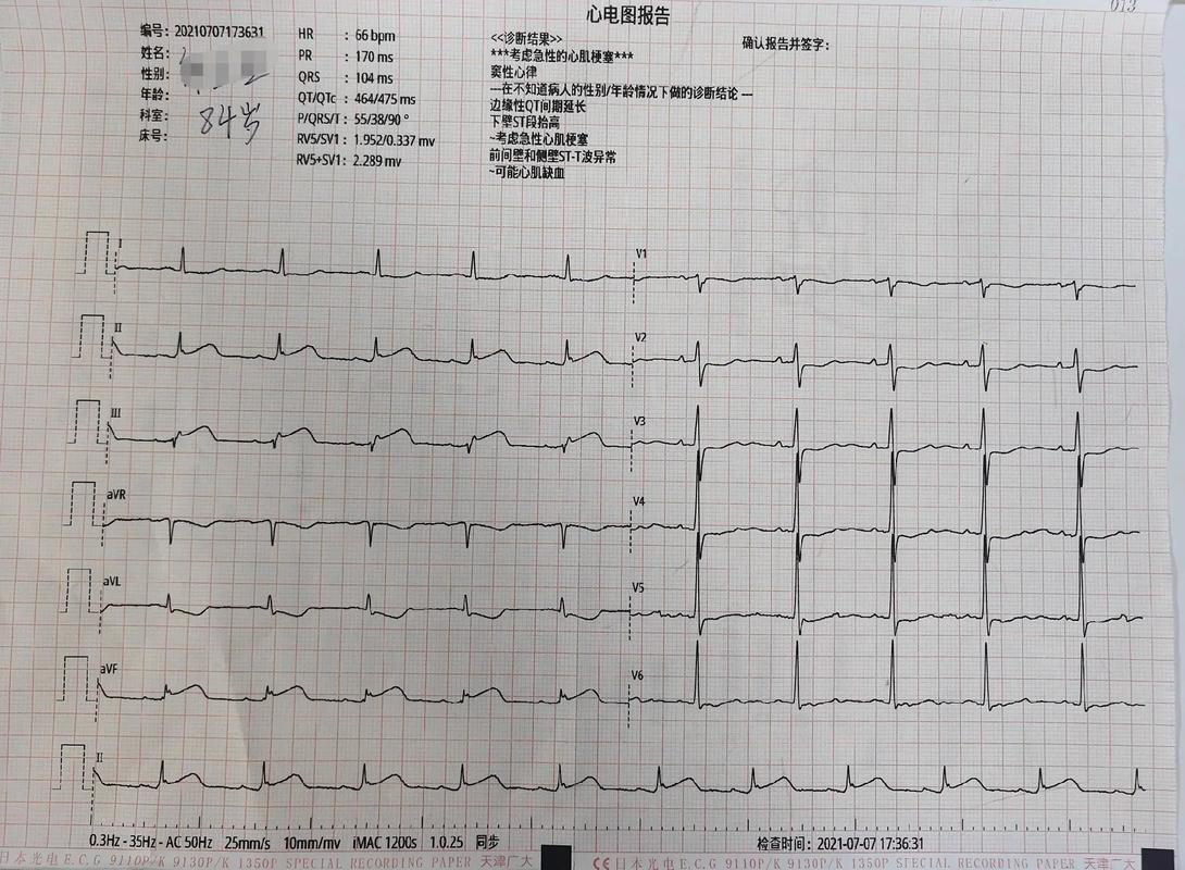 心电图能检查出脑脑梗吗