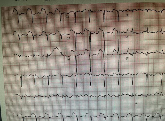 心电图能检查出脑脑梗吗
