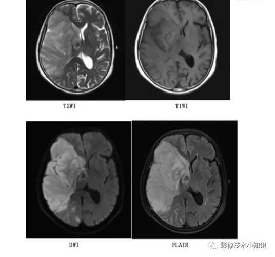 脑核磁能查出早期脑梗吗