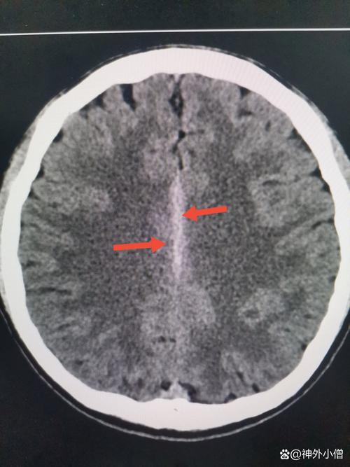 脑ct结果毛细血管脑梗