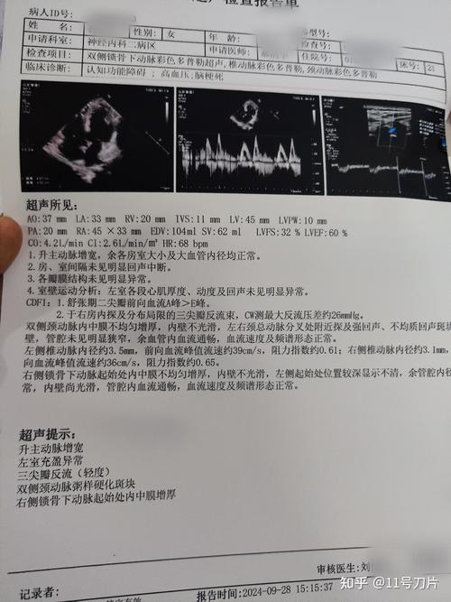 脑ct结果毛细血管脑梗