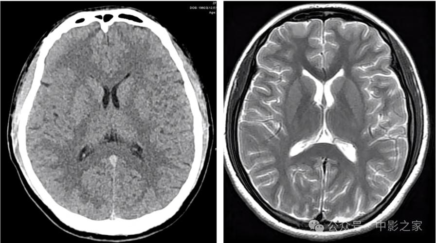 脑ct正常会突然脑梗么