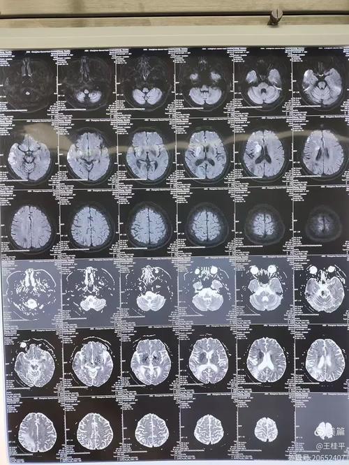 脑ct正常会突然脑梗么