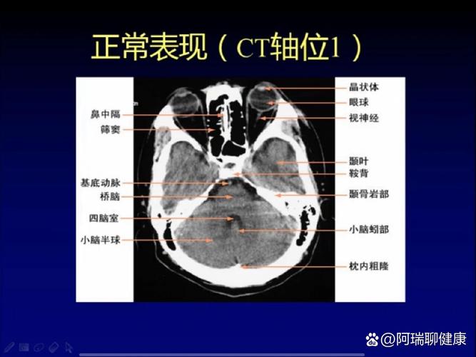 脑ct正常会突然脑梗么