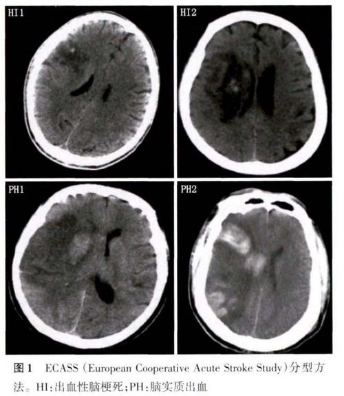 出现脑梗前兆脑ct正常