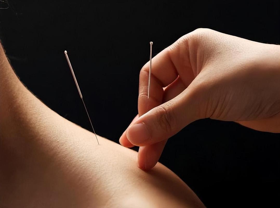 脑干梗塞昏迷针灸穴位