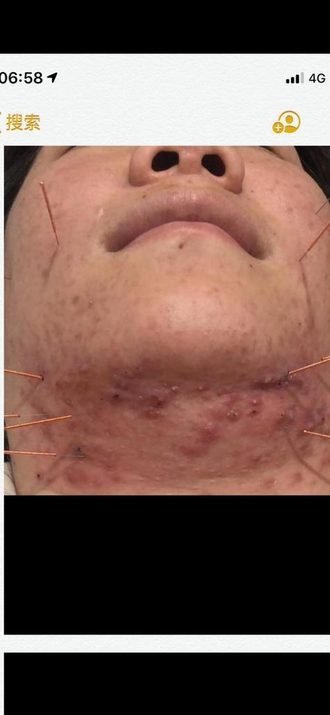 脸部痤疮在哪穴位放血