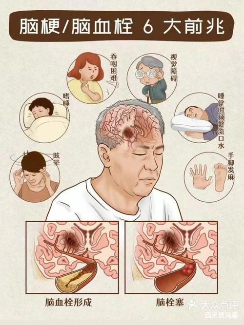 脑梗 失禁 口水 抽搐