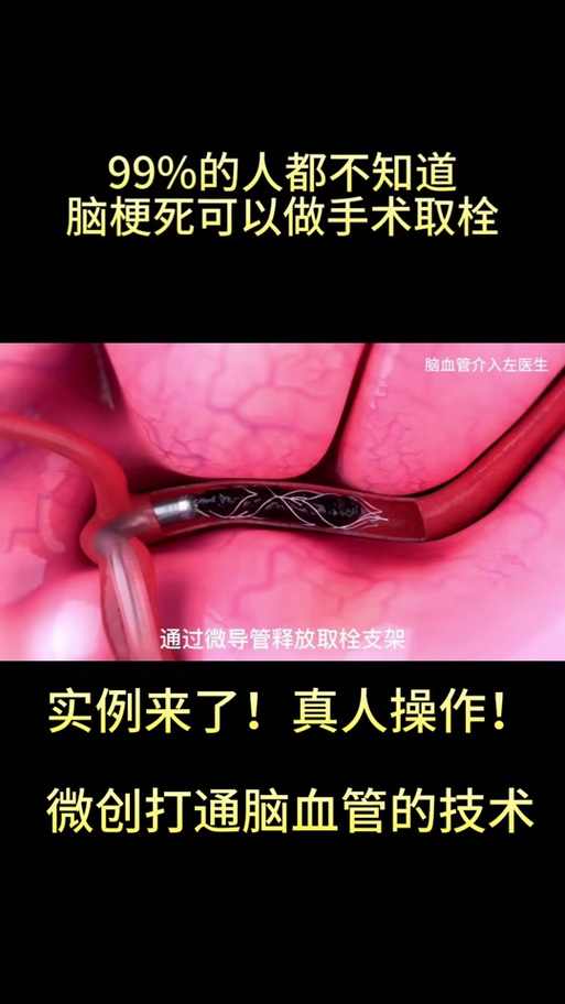 左脑脑梗坏死需要手术吗