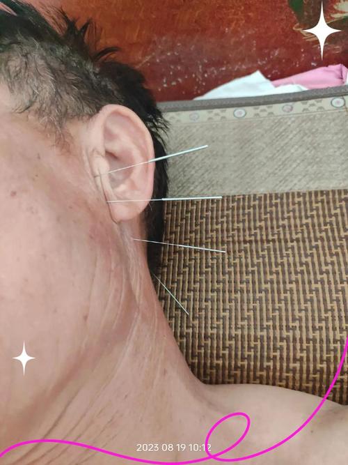 说话不清针灸哪些穴位