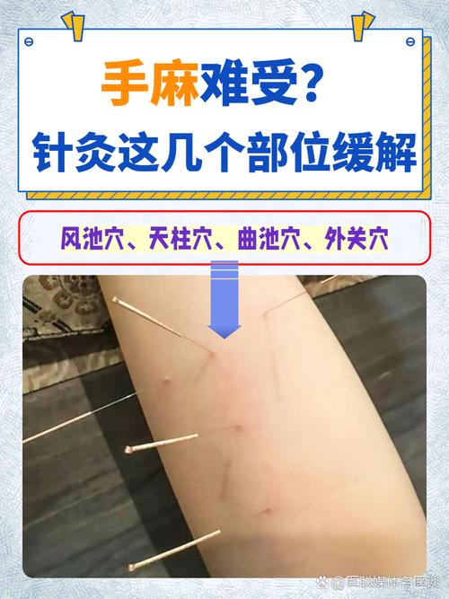 手脚发麻针炙什么穴位