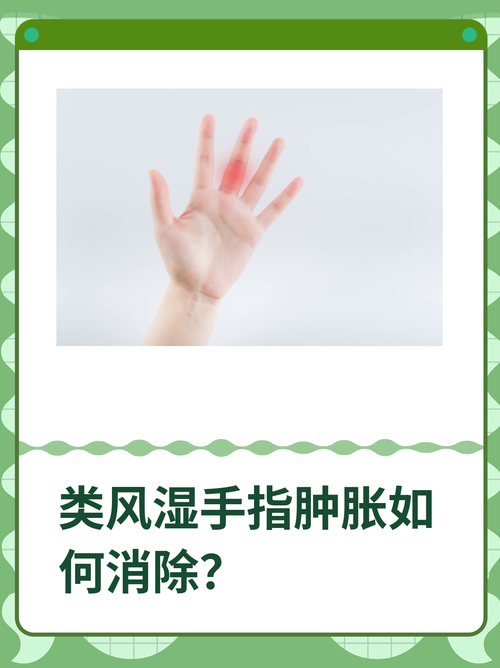 手指风湿与类风湿的区别