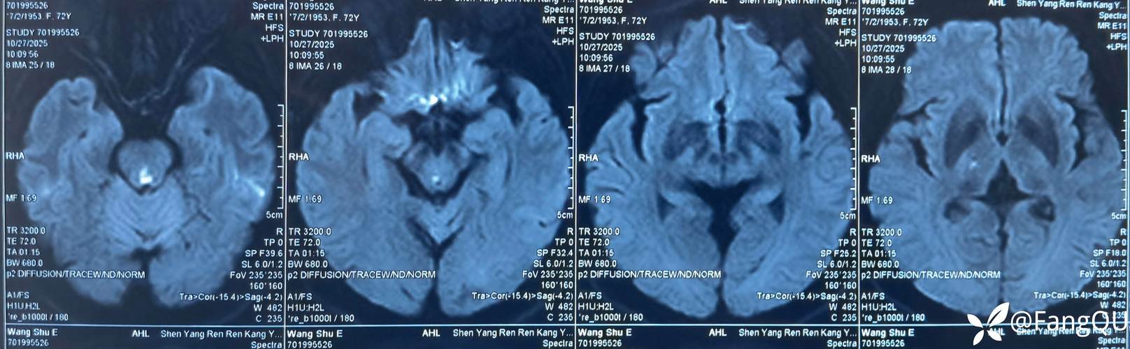 脑梗 icu 梗在脑干