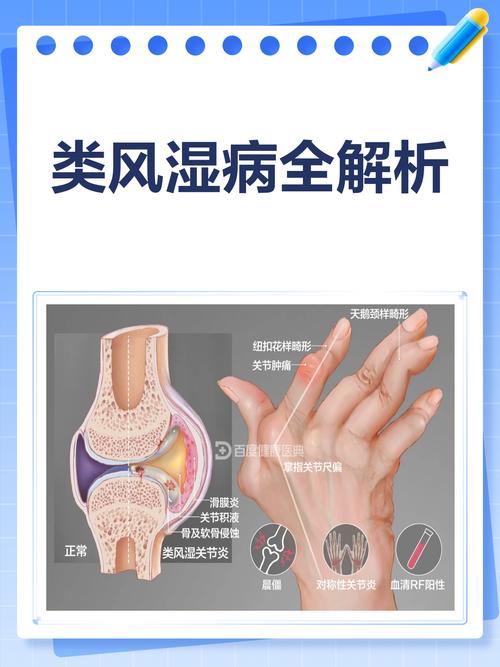 胡氏中医骨科风湿类风湿