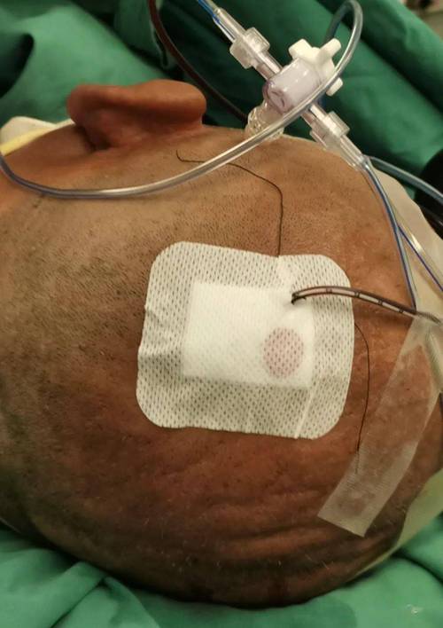 脑梗脑血肿引流管再出血