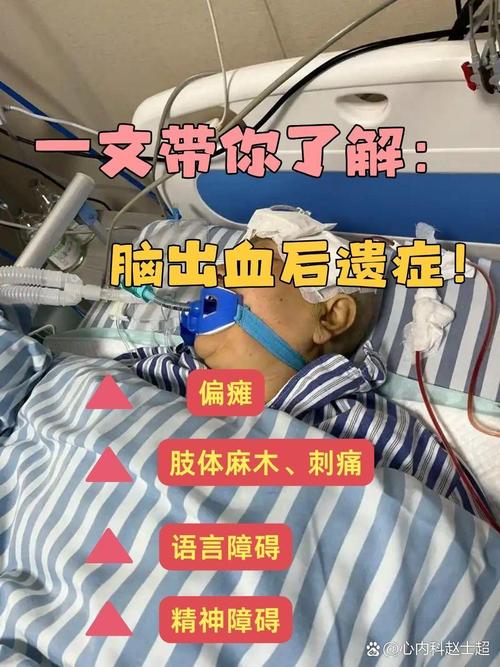 脑梗脑血肿引流管再出血